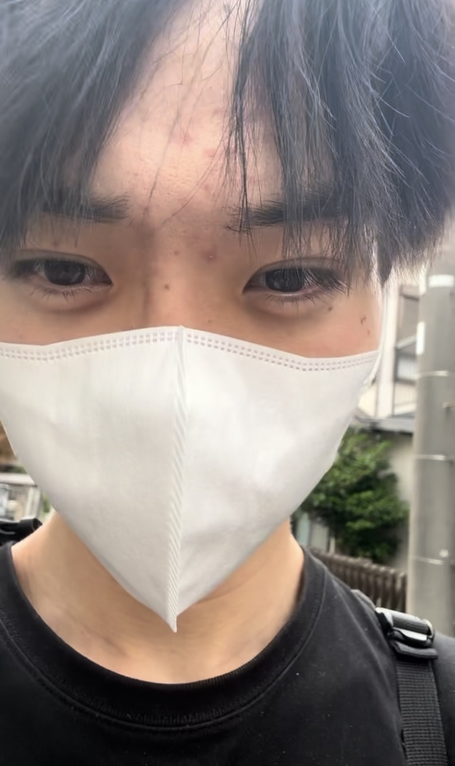 にきび撲滅隊