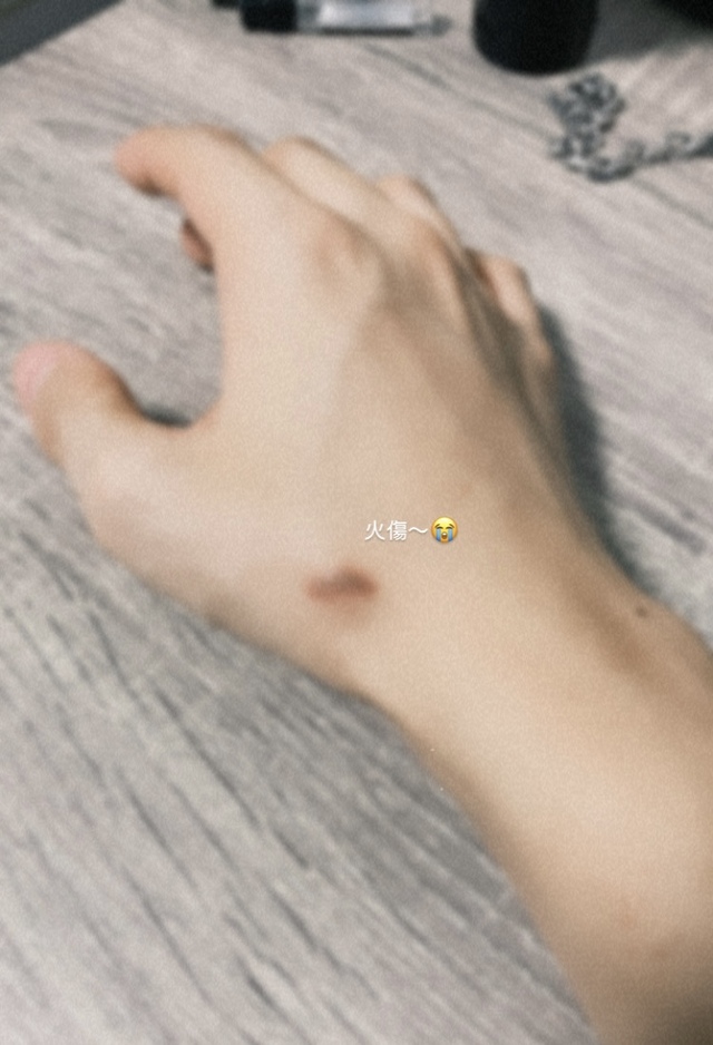 火傷〜😭